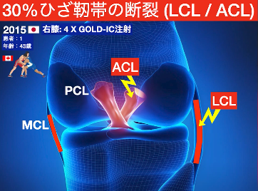 【膝の再生医療】最新治療のGOLD-ICを海外の専門家が徹底解説【PRP GOLD】