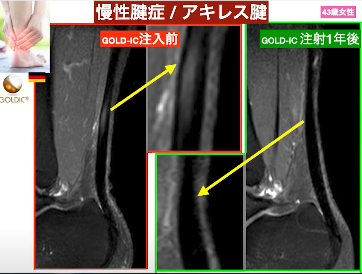 【膝の再生医療】最新治療のGOLD-ICを海外の専門家が徹底解説【PRP GOLD】