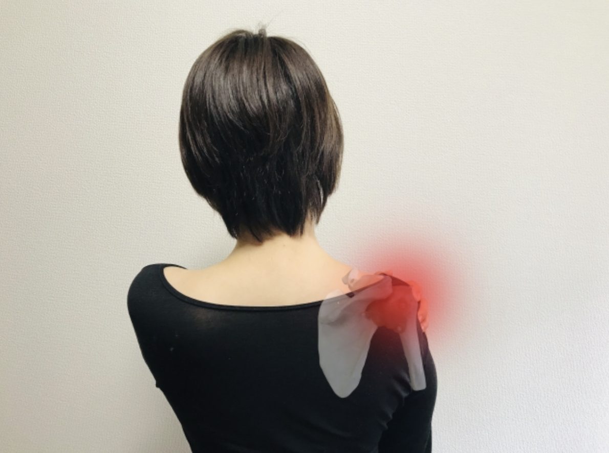 肩の石灰化はどのくらいで治るの？痛みを和らげるリハビリについて解説