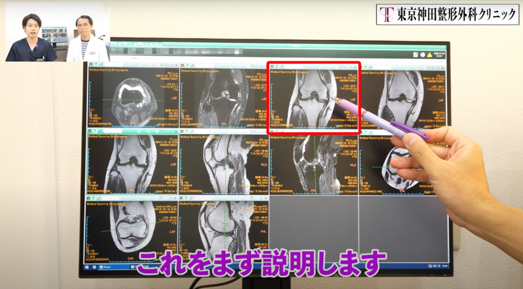 膝のMRIの見方とは？再生医療を行った方の画像を用いて解説！