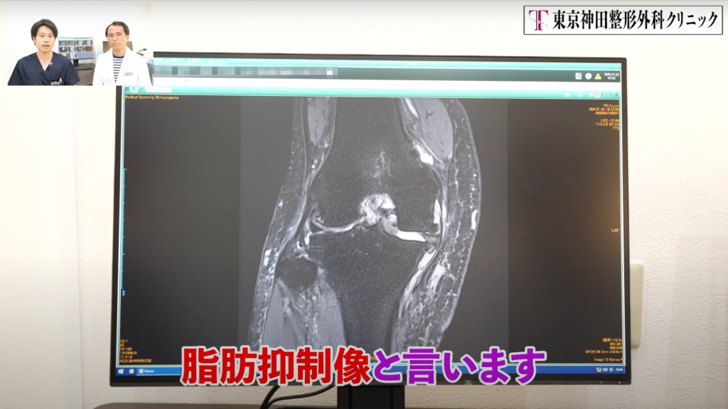 膝のMRIの見方とは？再生医療を行った方の画像を用いて解説！