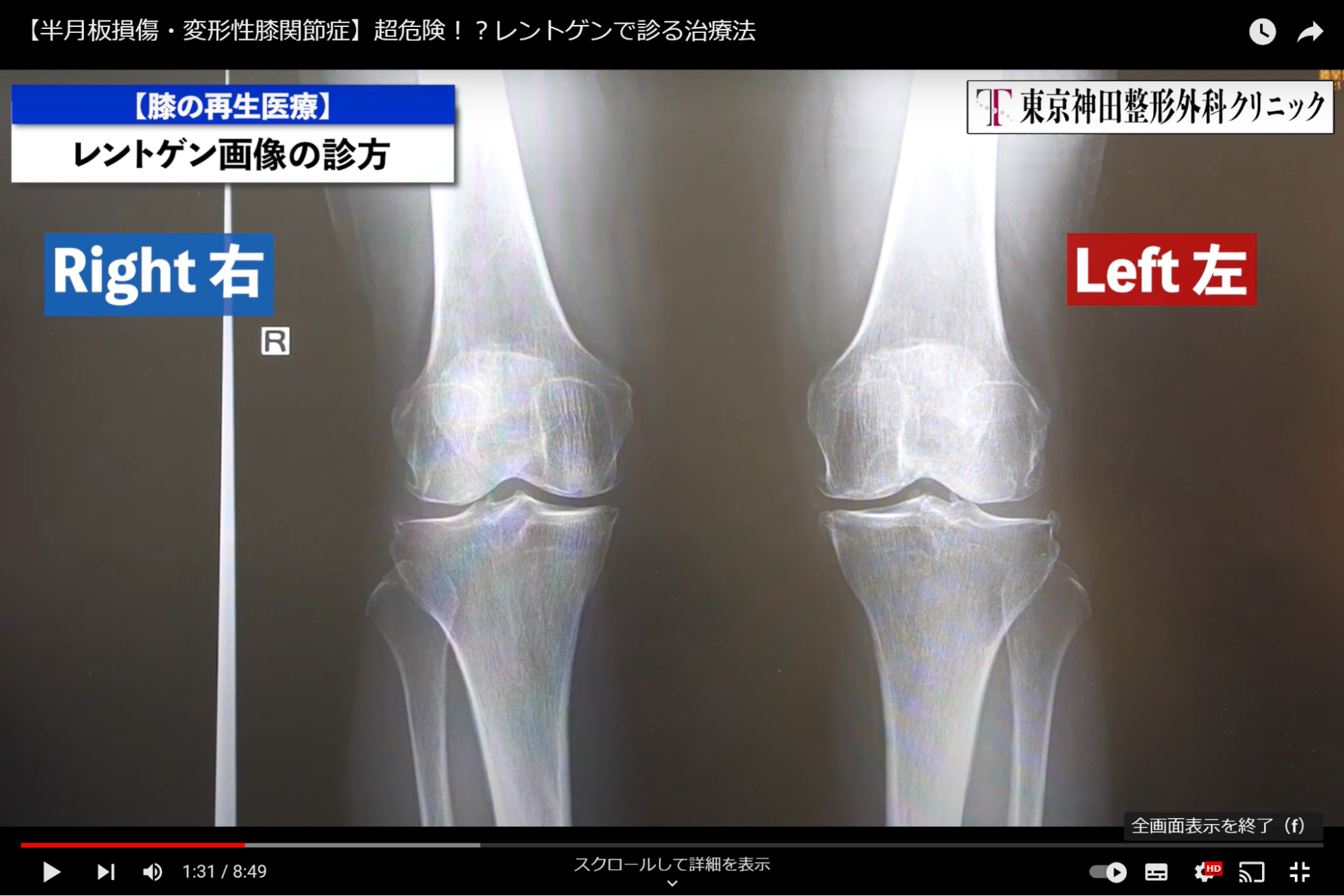 右変形性膝関節症看護 _ 変形性膝関節症 解剖生理 | 膝関節外科グループ – KUQS