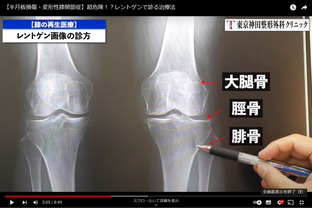 変形性膝関節症はレントゲンでわかる！画像所見を解説！