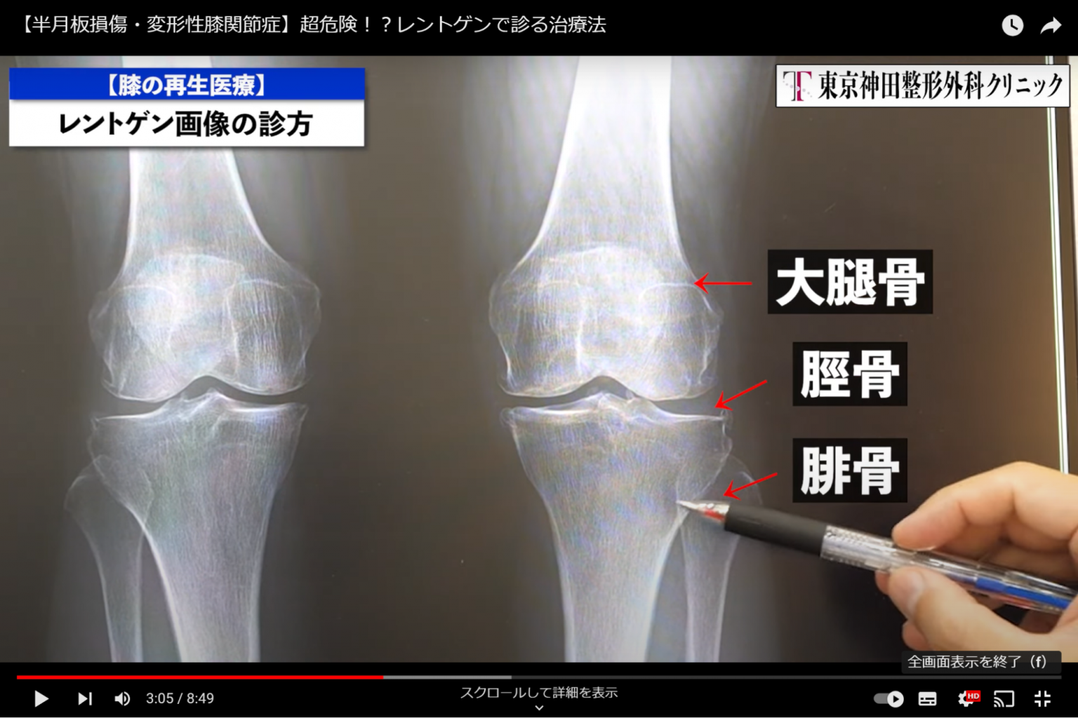 変形性膝関節症はレントゲンでわかる!画像所見を解説! | 【身長先生】のクリニック、東京神田整形外科クリニック