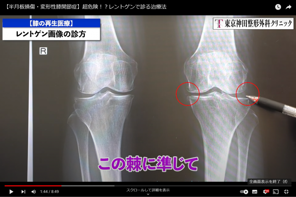 変形性膝関節症はレントゲンでわかる！画像所見を解説！