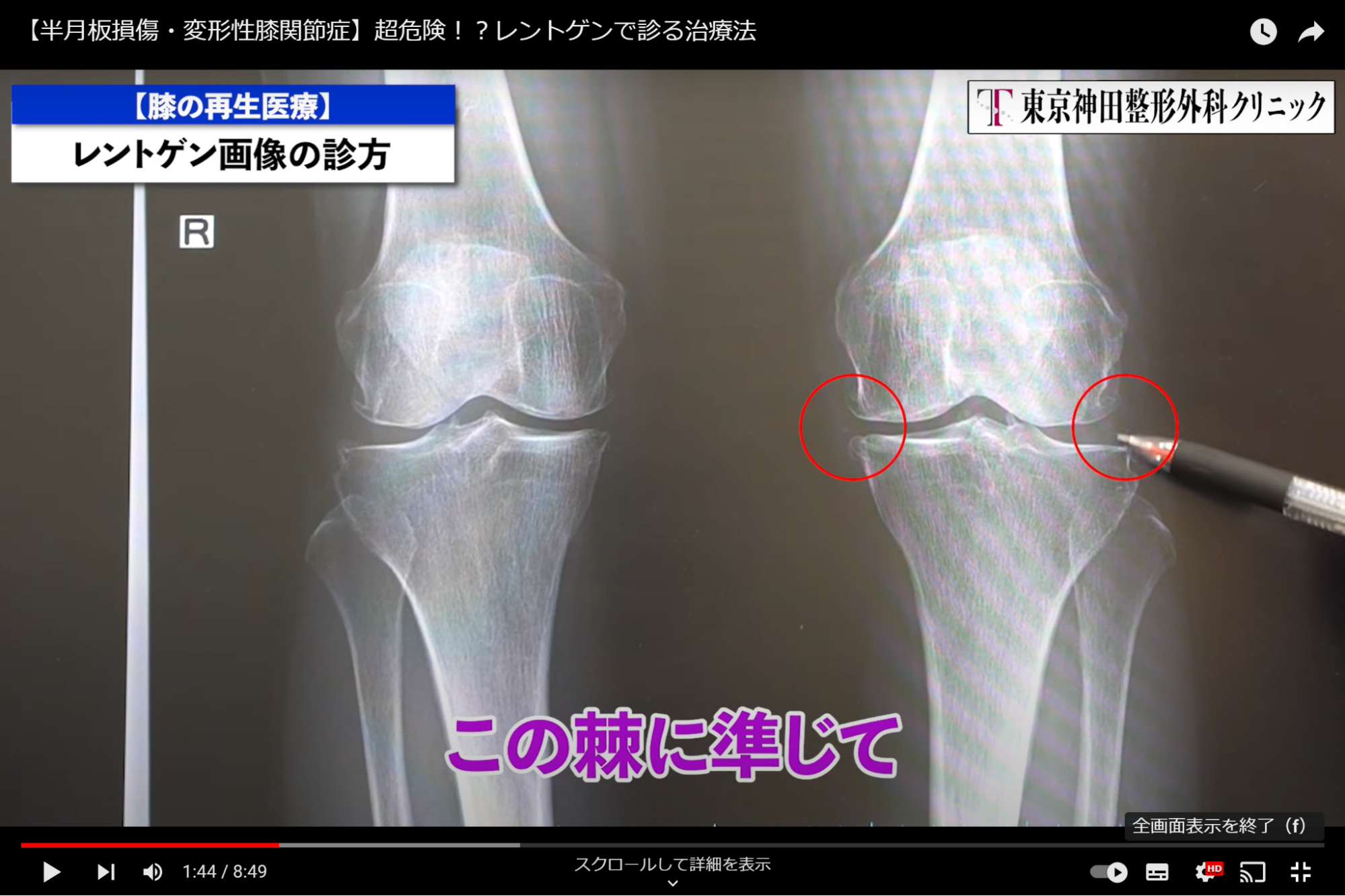 変形性膝関節炎治療 _ 変形性膝関節症 自分で治す : 関節鏡下滑膜切除術/関節鼠(遊離体)摘出術 – VEILHM