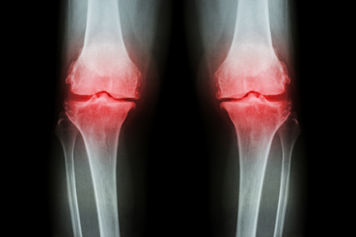 膝がまっすぐ伸びない原因とは？痛みにも効くストレッチをご紹介！