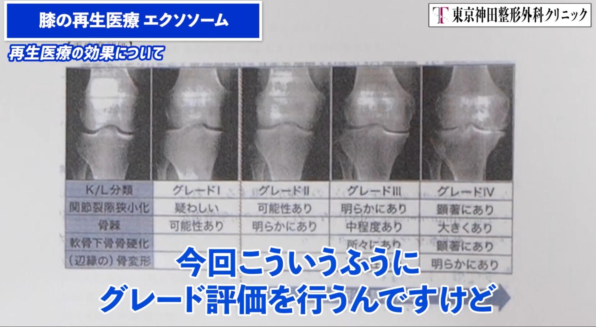 膝のエクソソーム治療後の効果は？【50代男性１回目注射の体験談】