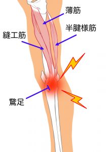 膝の皿の下側や内側の痛みは一体なぜ？原因と改善方法を徹底解説！   