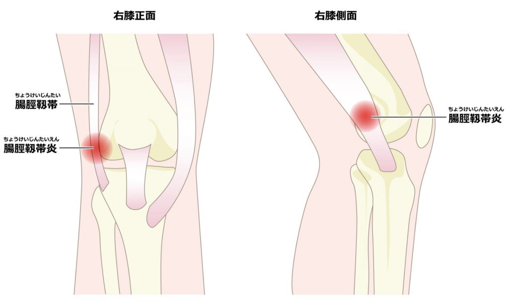歩くと痛い膝の外側の症状は治るの？原因と改善方法を解説します！