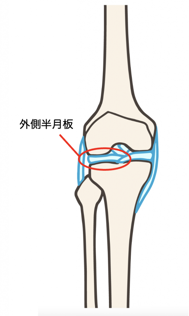 歩くと痛い膝の外側の症状は治るの？原因と改善方法を解説します！