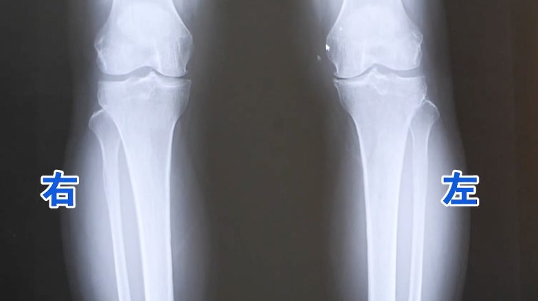 膝の臍帯由来ウォートンジェリーエクソソームの体験談(注射１回目)