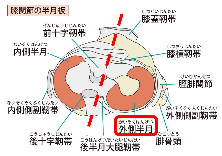 膝の外側の骨を押すと痛い！その痛みの原因と対処法を徹底解説します