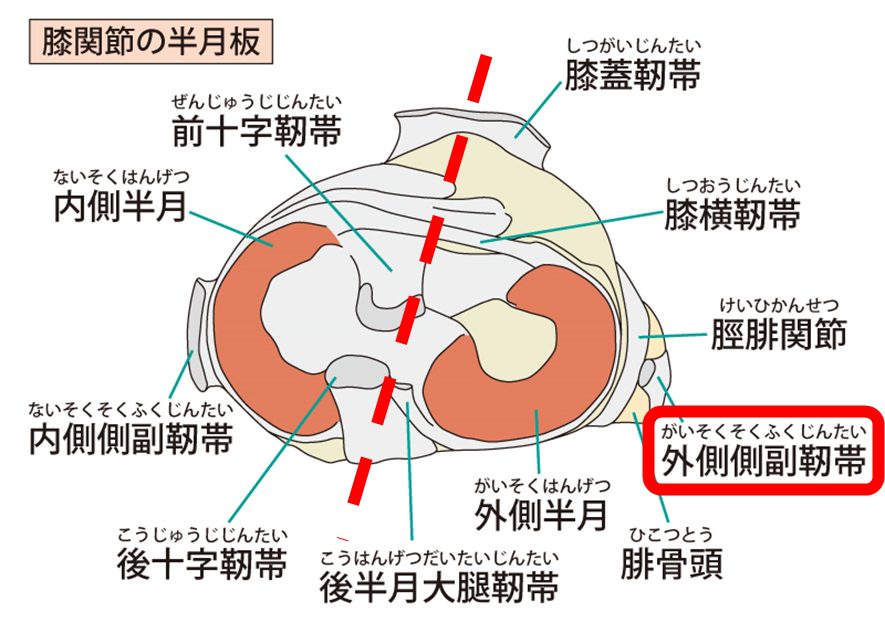 膝の外側の骨を押すと痛い！その痛みの原因と対処法を徹底解説します