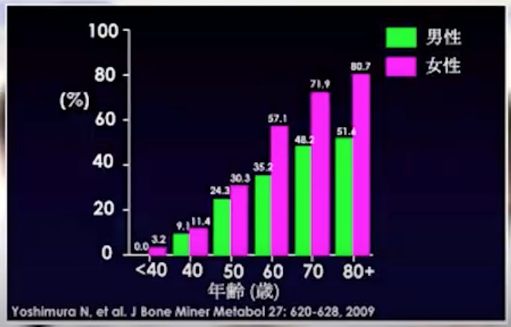 膝痛の原因と治し方について【変形性膝関節症に対するエクソソーム治療】