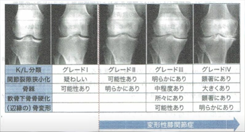 【57歳女性】左膝の前後の痛みに1000億個エクソソーム【リハビリも重要】