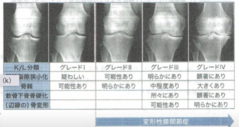 人工関節しかない？手術しない治療を57歳女性が選択した理由①