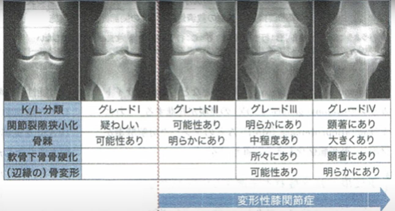 エクソソームは有効？46歳男性の膝をもとに解説①