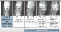 1000億エクソソームでひざ痛が治る？41歳男性の体験談②