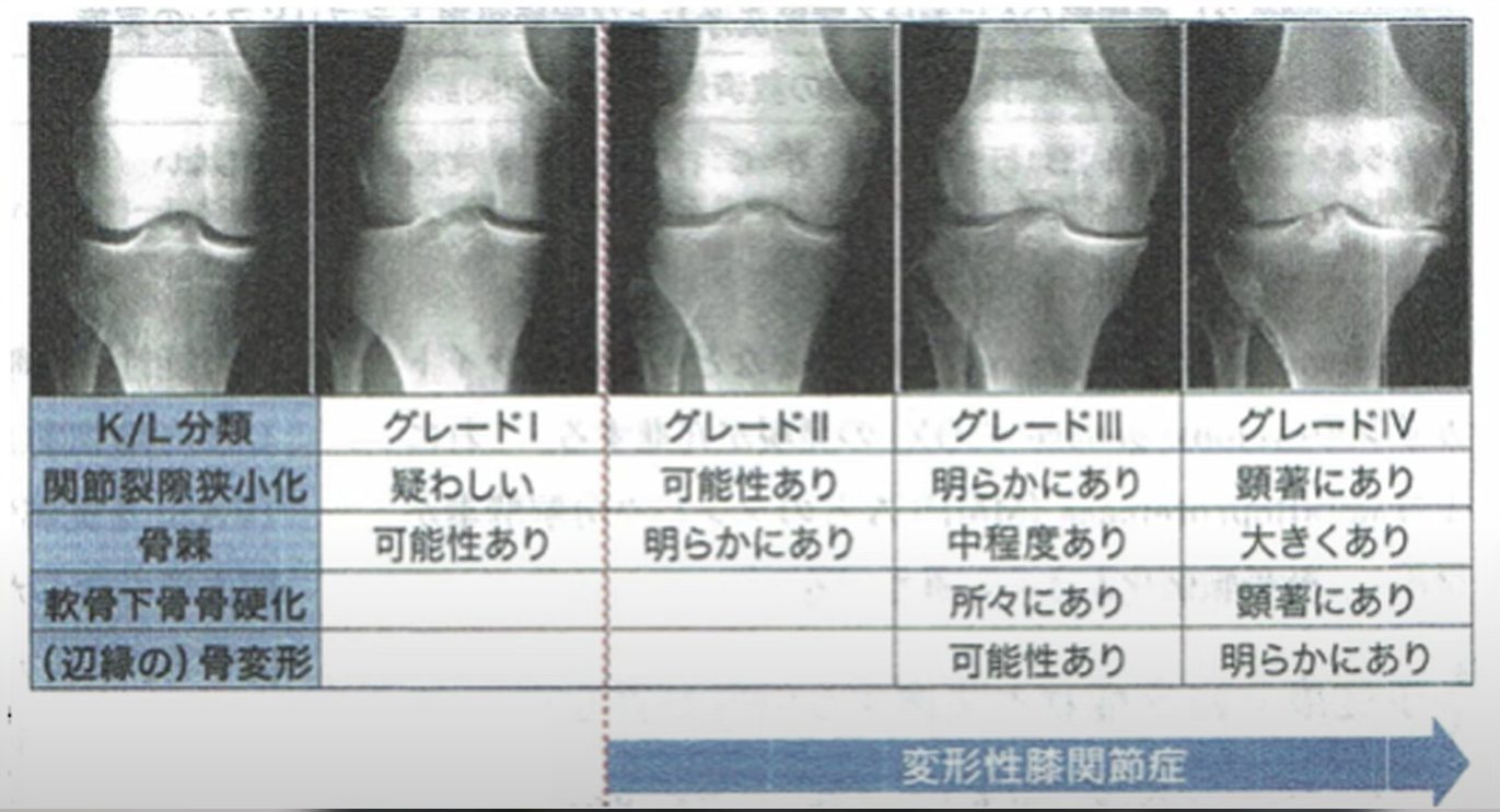 手術するのはちょっと待って！治療効果96%のエクソソームとは！