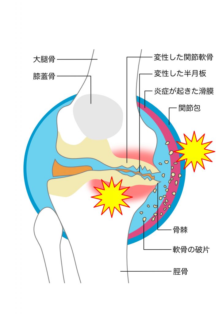 変形性膝関節症に効果的なストレッチ5選！簡単な運動から始めよう
