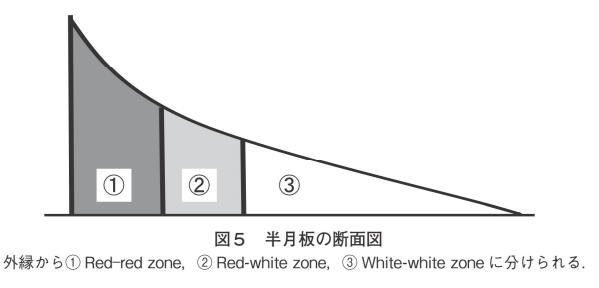 半月板損傷でやってはいけないこと！整形外科医が解説する正しい対処法