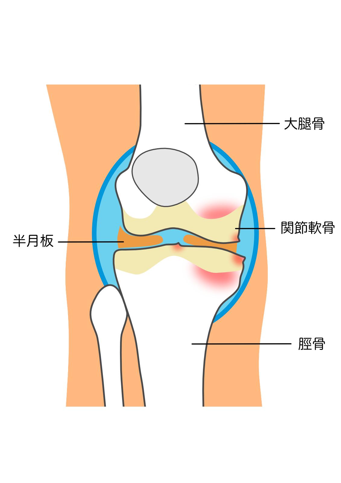 "半月板損傷を早く治すための 具体的なリハビリ方法 "