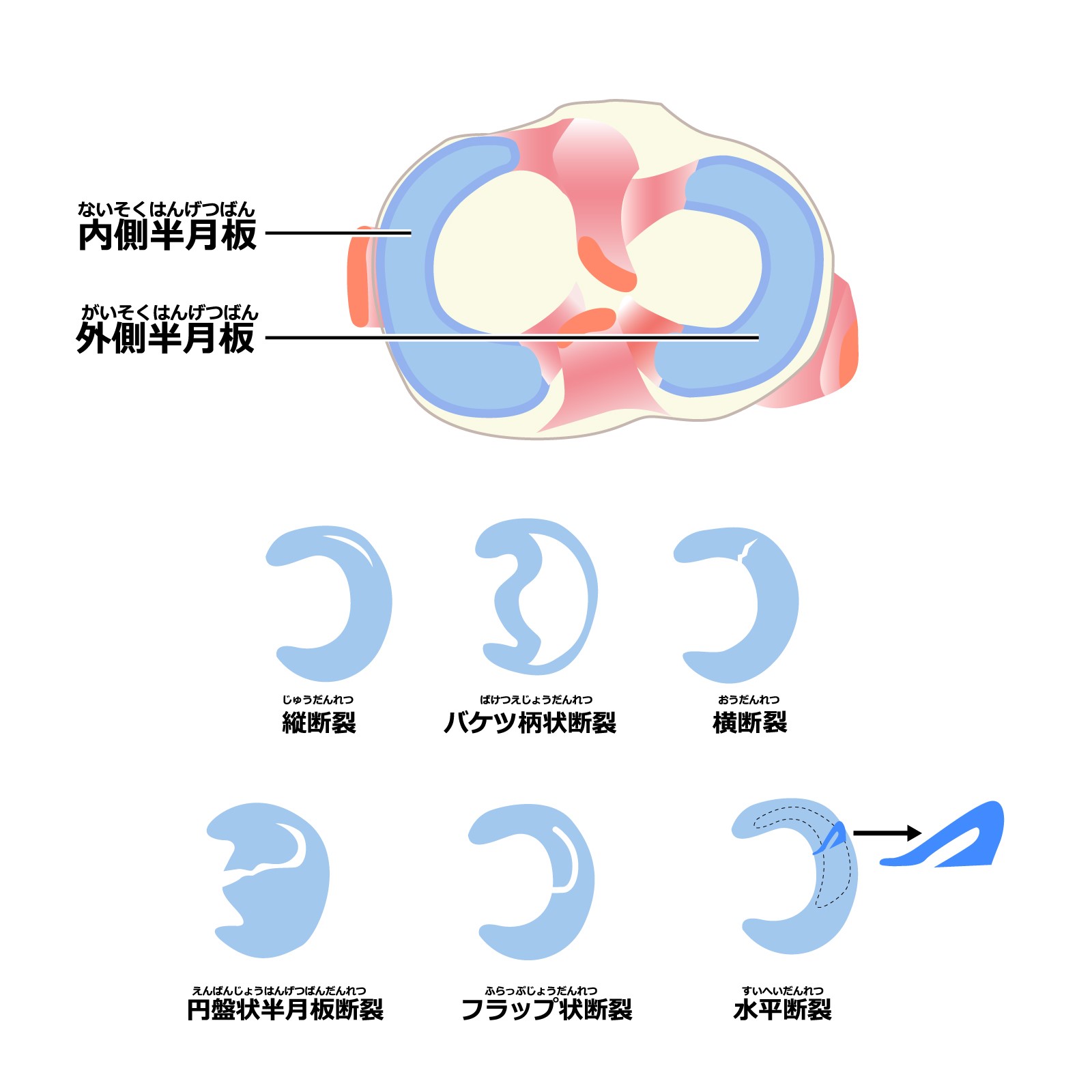 "半月板損傷を早く治すための 具体的なリハビリ方法 "