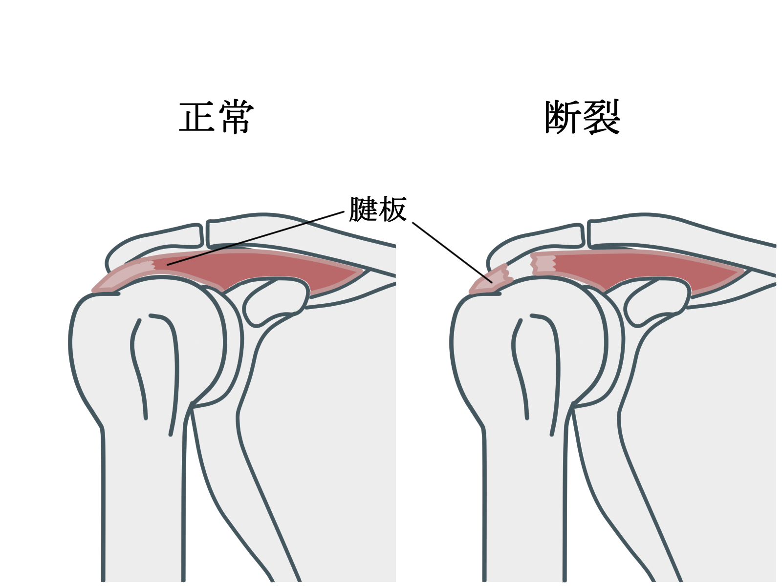 肩腱板断裂はどのくらいで治る？保存療法とリハビリの目安